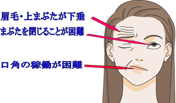 顔面神経麻痺（ベル麻痺）の画像