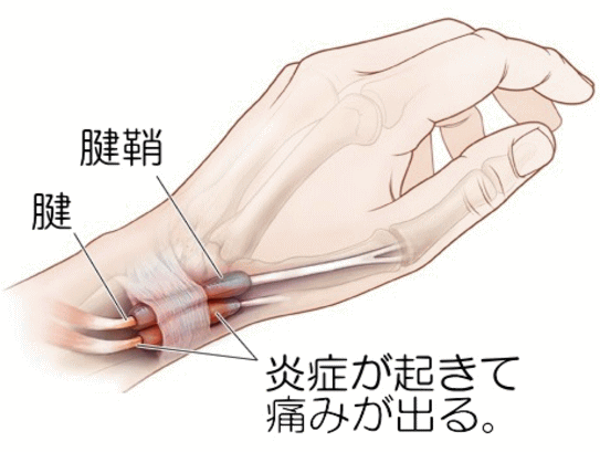手首の狭窄性腱鞘炎の写真説明