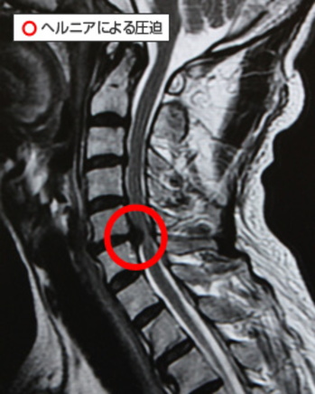 頸椎症 頸椎ヘルニア ストレートネック 頸椎神経根症の画像
